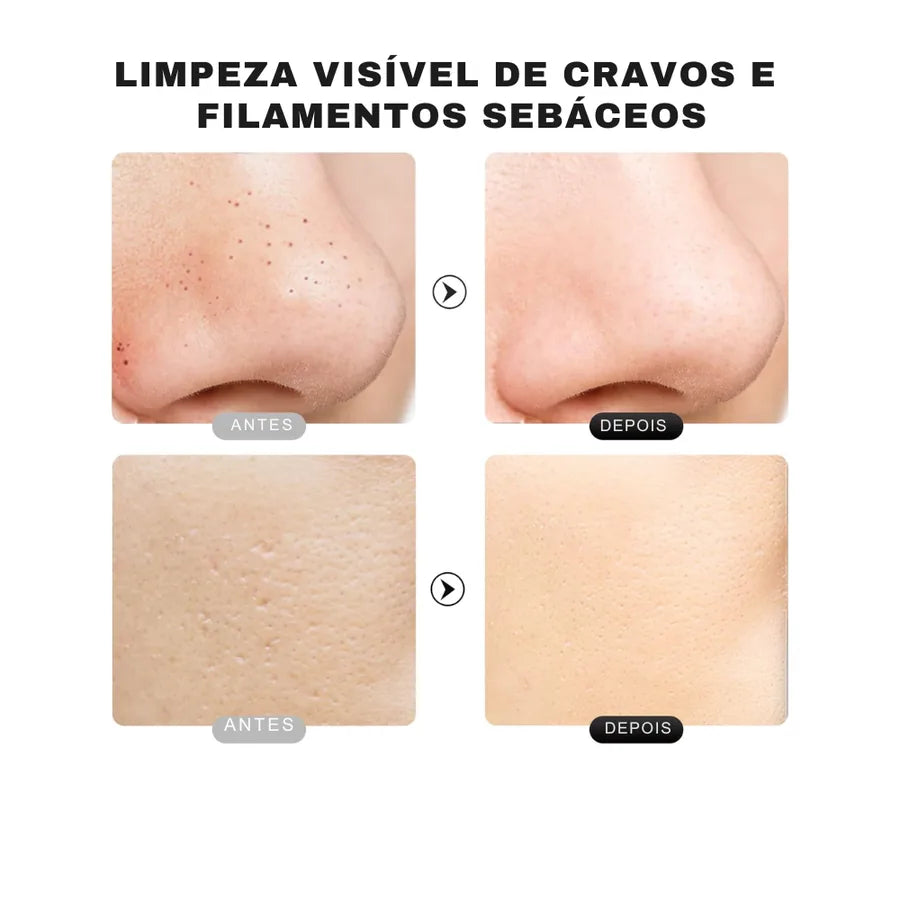 Extrator Ultrassônico com Ions - Removedor de Cravo, Limpeza Profunda dos Poros do Rosto - foto 2