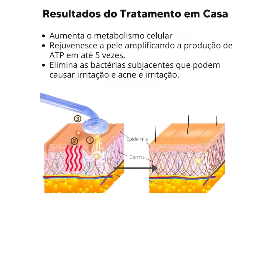 Aparelho de Alta Frequência DARSONVAL- 6 em 1, Terapia Facial Anti Sinais, Acne e Cabelo - foto 4