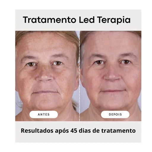 Máscara Facial LED Terapia Photon High 7 Cores em Silicone com 110 Leds - Anti Sinais - foto 4